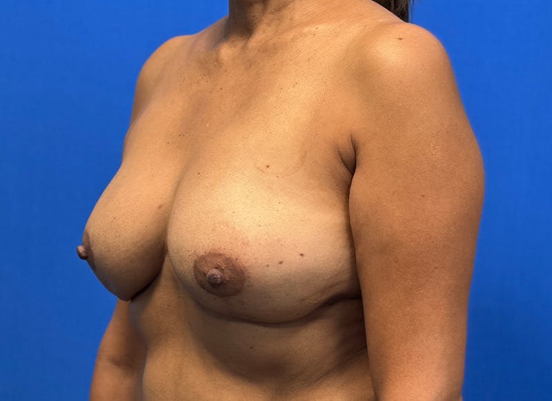 Flap Reconstruction Gallery Before & After Gallery - Patient 112338049 - Image 4