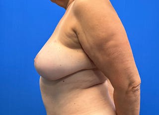 Flap Reconstruction Gallery Before & After Gallery - Patient 593293 - Image 2