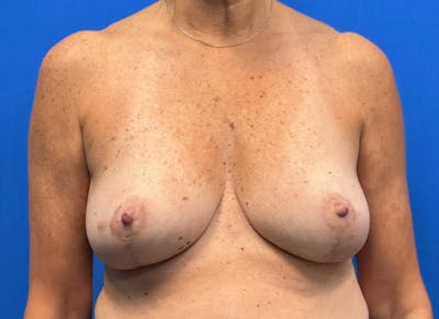 Breast Reduction Before & After Gallery - Patient 623681 - Image 6