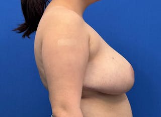 Breast Reduction Before & After Gallery - Patient 102661 - Image 10
