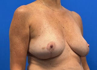 Breast Reduction Before & After Gallery - Patient 623681 - Image 8