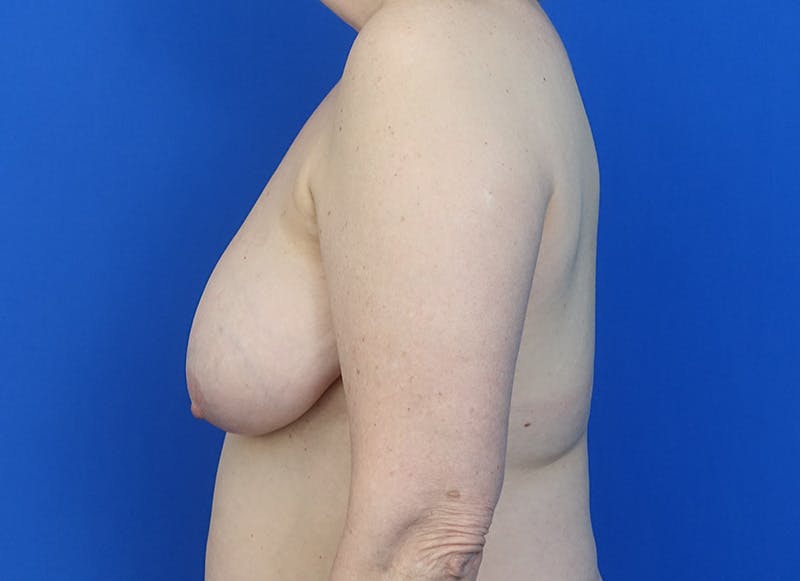 Breast Reduction Before & After Gallery - Patient 121727721 - Image 1