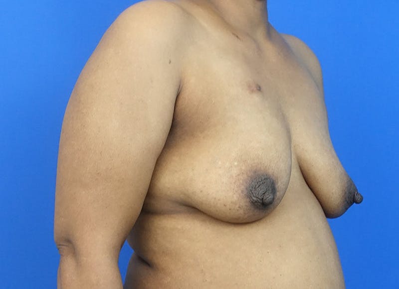Flap Reconstruction Gallery Before & After Gallery - Patient 229792 - Image 7