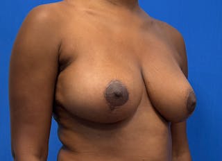Breast Reduction Before & After Gallery - Patient 359699 - Image 8