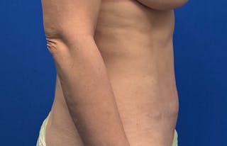 Abdominoplasty Before & After Gallery - Patient 445970 - Image 10