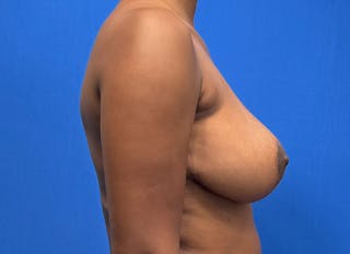 Breast Reduction Before & After Gallery - Patient 359699 - Image 10