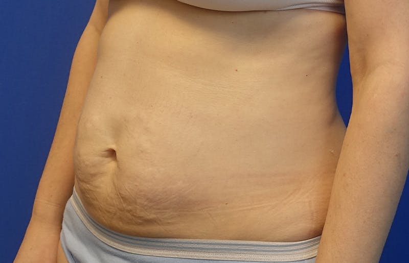Abdominoplasty Before & After Gallery - Patient 445970 - Image 3