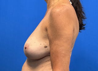Breast Reduction Before & After Gallery - Patient 623681 - Image 2