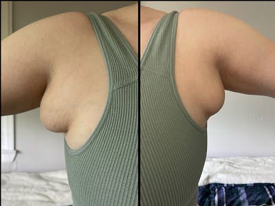 Axillary Breast Removal Before & After Gallery - Patient 112338655 - Image 1