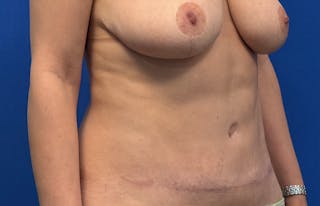 Abdominoplasty Before & After Gallery - Patient 445970 - Image 8