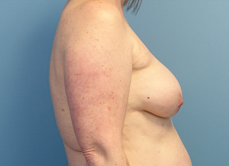 Flap Reconstruction Gallery Before & After Gallery - Patient 415135 - Image 9