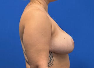Breast Reduction Before & After Gallery - Patient 442749 - Image 10