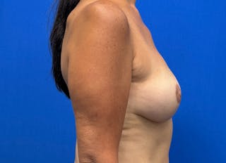 Flap Reconstruction Gallery Before & After Gallery - Patient 218210 - Image 10
