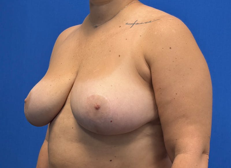 Breast Reduction Before & After Gallery - Patient 442749 - Image 4