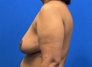 Breast Reduction Before & After Gallery - Patient 352522 - Image 2