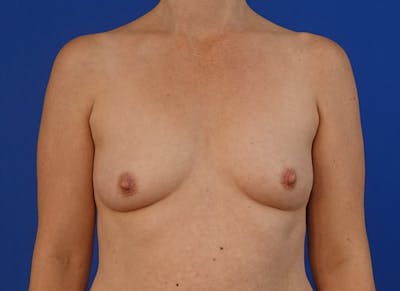 Implant Reconstruction Gallery Before & After Gallery - Patient 112337922 - Image 5