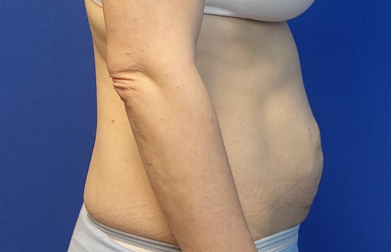 Abdominoplasty Before & After Gallery - Patient 445970 - Image 9