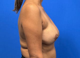 Flap Reconstruction Gallery Before & After Gallery - Patient 112338049 - Image 10
