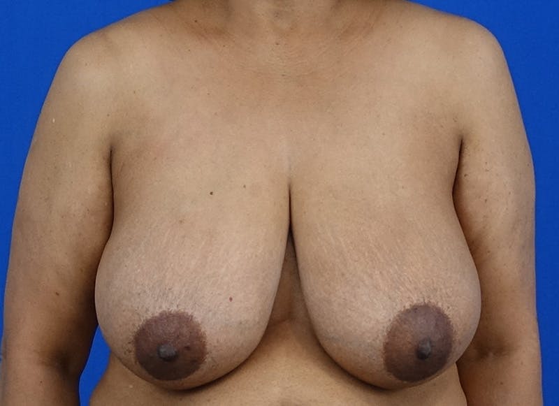 Breast Reduction Before & After Gallery - Patient 352522 - Image 5