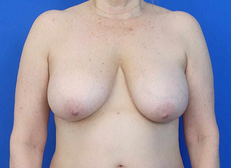 Breast Reduction Before & After Gallery - Patient 121727721 - Image 5