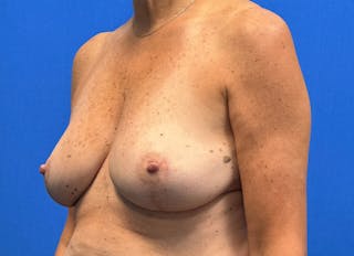 Breast Reduction Before & After Gallery - Patient 623681 - Image 4