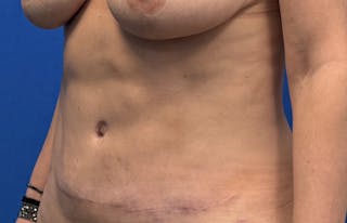 Abdominoplasty Before & After Gallery - Patient 445970 - Image 4