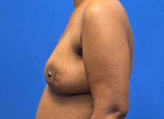 Flap Reconstruction Gallery Before & After Gallery - Patient 229792 - Image 2