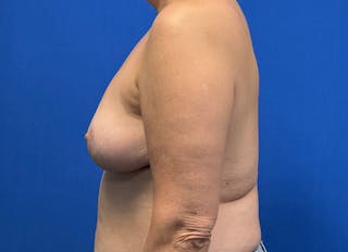 Breast Reduction Before & After Gallery - Patient 121727721 - Image 2