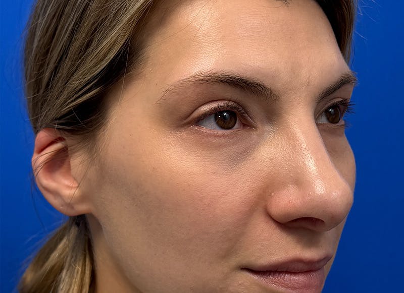 Rhinoplasty Before & After Gallery - Patient 121727056 - Image 8
