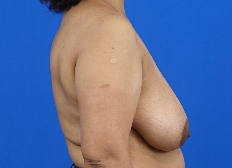 Breast Reduction Before & After Gallery - Patient 352522 - Image 9