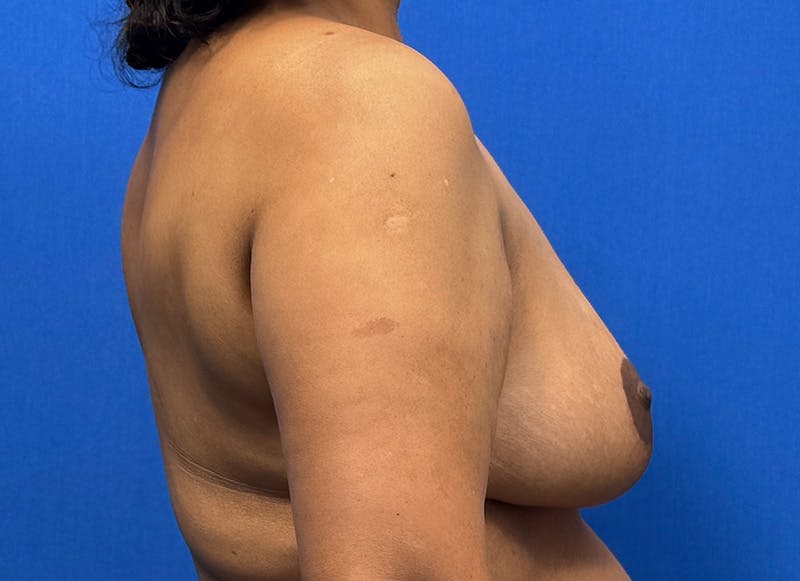 Breast Reduction Before & After Gallery - Patient 352522 - Image 10