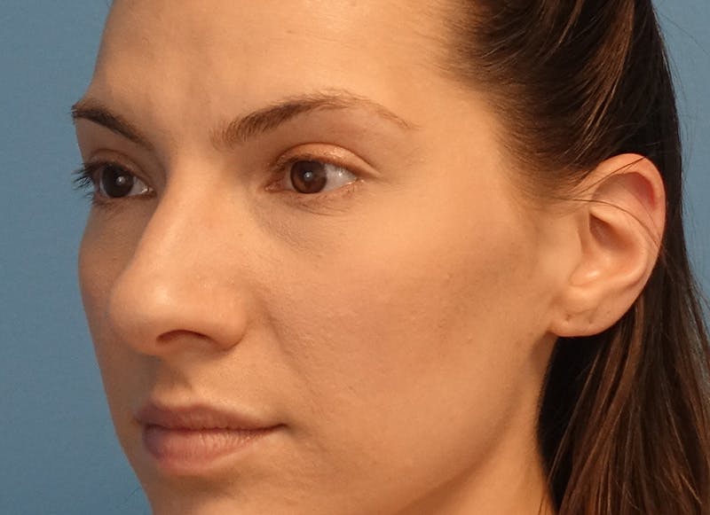 Rhinoplasty Before & After Gallery - Patient 121727056 - Image 3