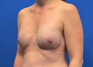 Implant Reconstruction Gallery Before & After Gallery - Patient 112337922 - Image 4