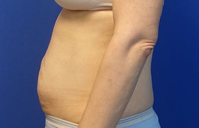 Abdominoplasty Before & After Gallery - Patient 445970 - Image 1