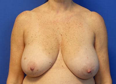 Breast Reduction Before & After Gallery - Patient 623681 - Image 5