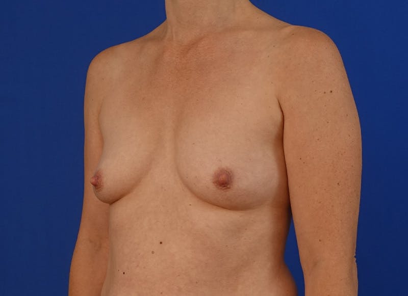 Implant Reconstruction Gallery Before & After Gallery - Patient 112337922 - Image 3