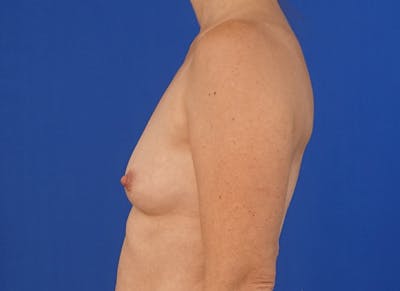 Implant Reconstruction Gallery Before & After Gallery - Patient 112337922 - Image 1