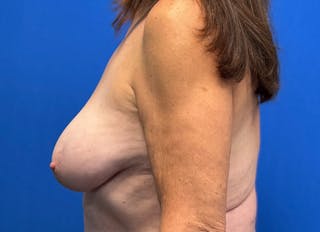 Breast Reduction Before & After Gallery - Patient 166839 - Image 2