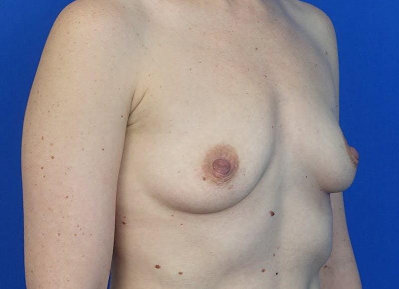 Augmentation Before & After Gallery - Patient 179248822 - Image 7