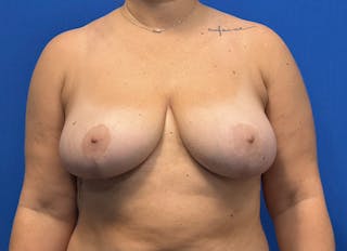Breast Reduction Before & After Gallery - Patient 442749 - Image 6