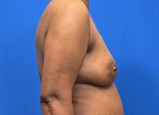 Flap Reconstruction Gallery Before & After Gallery - Patient 229792 - Image 10