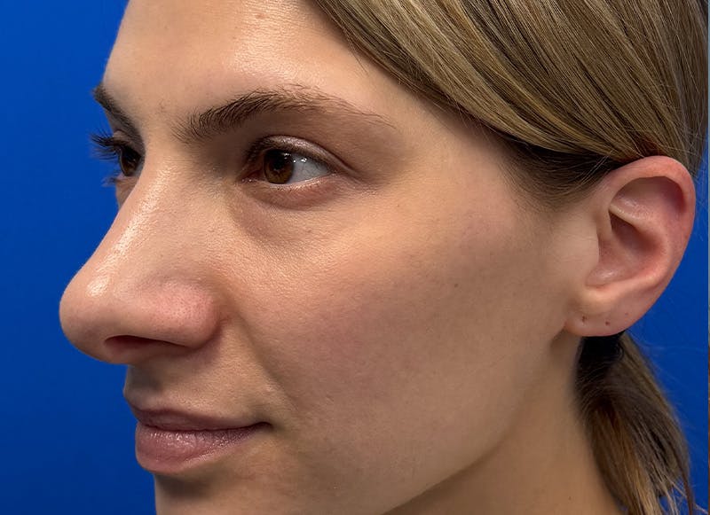 Rhinoplasty Before & After Gallery - Patient 121727056 - Image 4