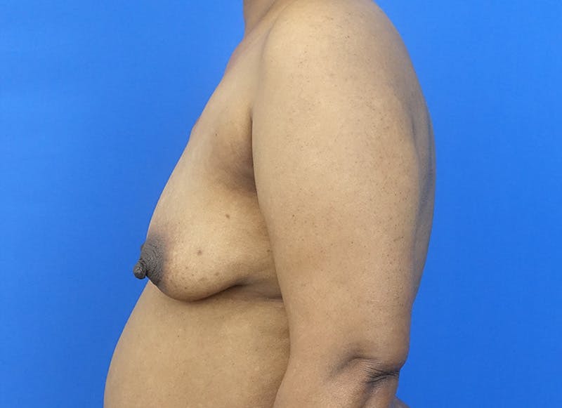 Flap Reconstruction Gallery Before & After Gallery - Patient 229792 - Image 1