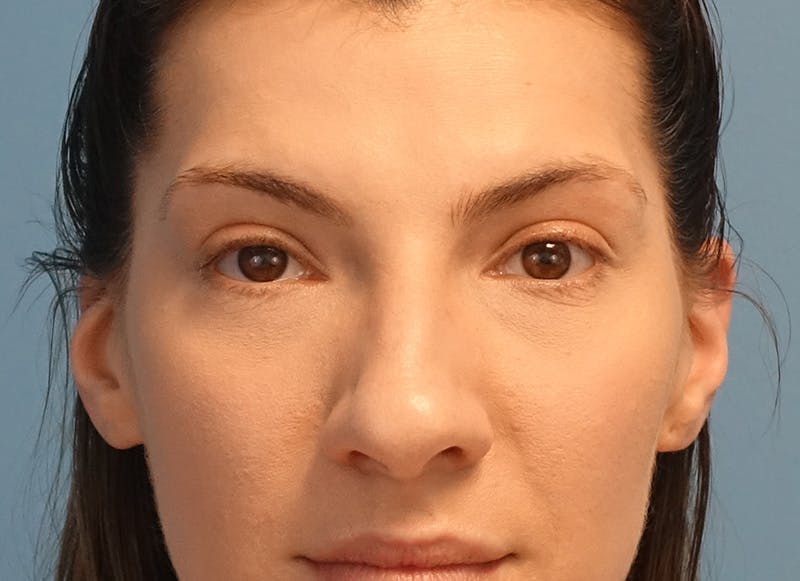 Rhinoplasty Before & After Gallery - Patient 121727056 - Image 5