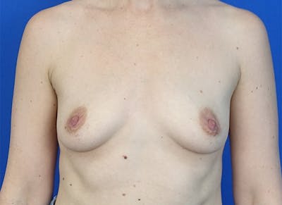 Augmentation Before & After Gallery - Patient 179248822 - Image 5