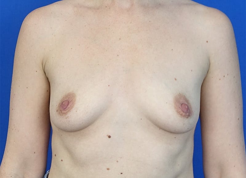 Augmentation Before & After Gallery - Patient 179248822 - Image 5
