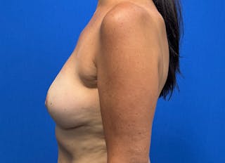 Flap Reconstruction Gallery Before & After Gallery - Patient 218210 - Image 2