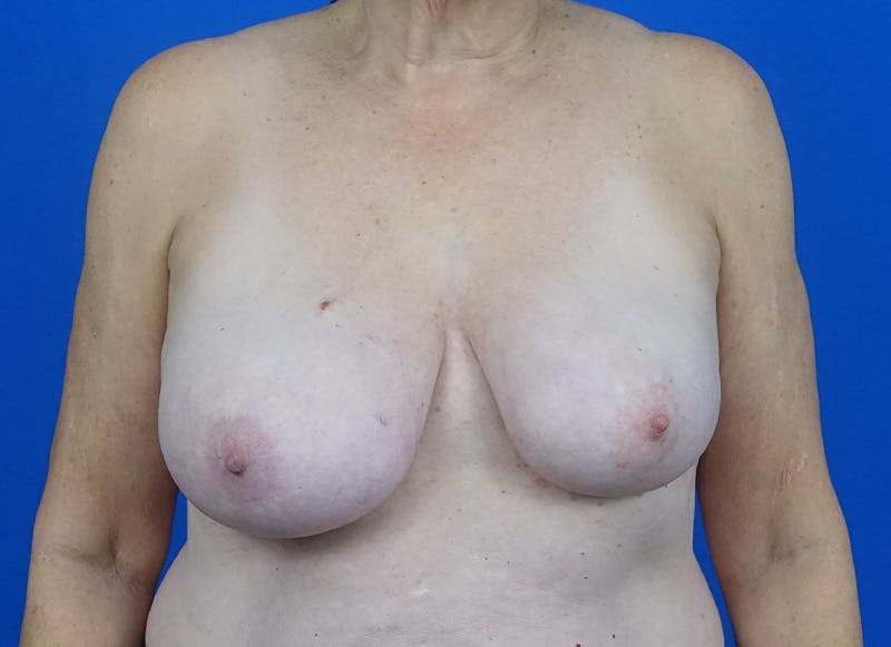 Breast Reduction Before & After Gallery - Patient 166839 - Image 5