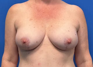 Flap Reconstruction Gallery Before & After Gallery - Patient 415135 - Image 6