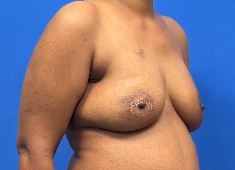 Flap Reconstruction Gallery Before & After Gallery - Patient 229792 - Image 8